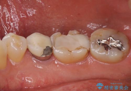 欠けてしまった奥歯 セラミッククラウンによる補綴治療の治療前