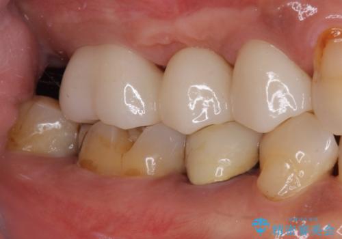 欠けてしまった奥歯 セラミッククラウンによる補綴治療の治療前