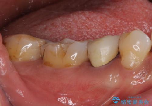欠けてしまった奥歯 セラミッククラウンによる補綴治療の治療前
