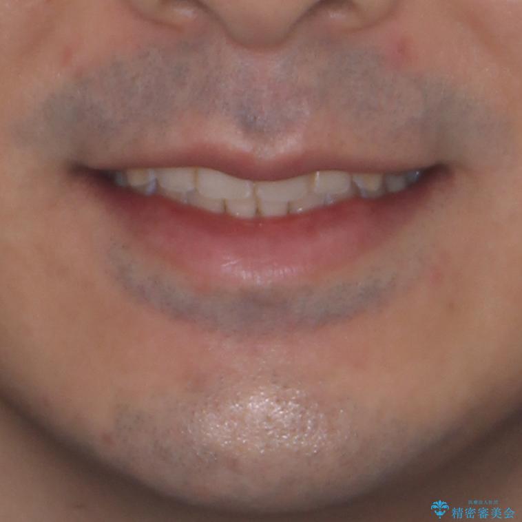 ディープバイトと叢生を解消 インビザライン矯正の治療後(顔貌)