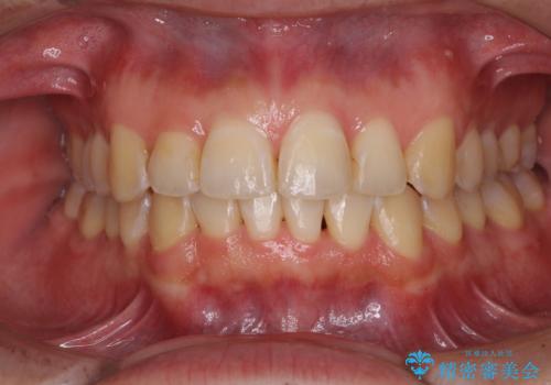 ディープバイトと叢生を解消 インビザライン矯正
