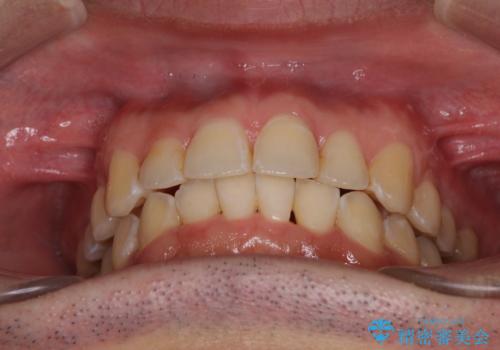 ディープバイトと叢生を解消 インビザライン矯正の治療後