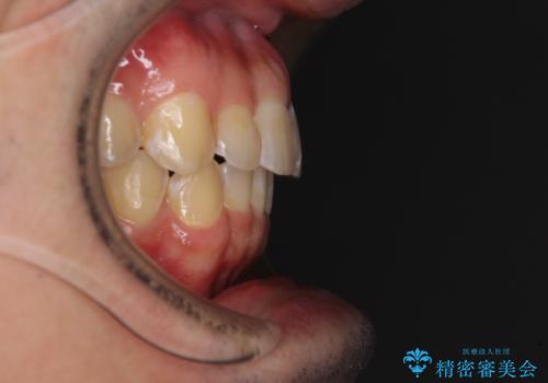ディープバイトと叢生を解消 インビザライン矯正の治療後