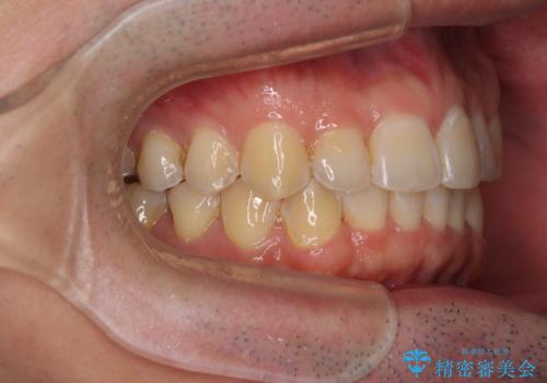 ディープバイトと叢生を解消 インビザライン矯正の治療後