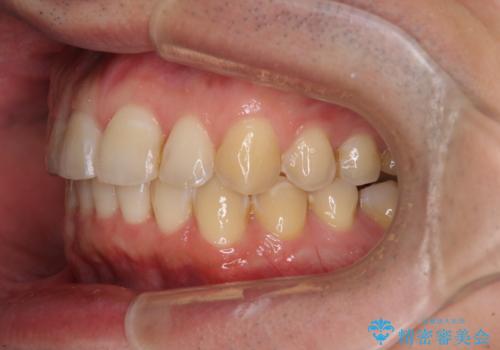 ディープバイトと叢生を解消 インビザライン矯正の治療後