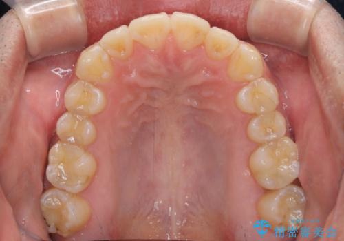 ディープバイトと叢生を解消 インビザライン矯正の治療後