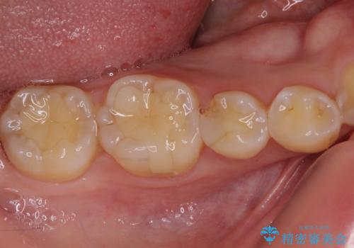 ディープバイトと叢生を解消 インビザライン矯正の治療中