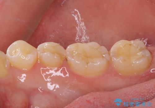 ディープバイトと叢生を解消 インビザライン矯正の治療中