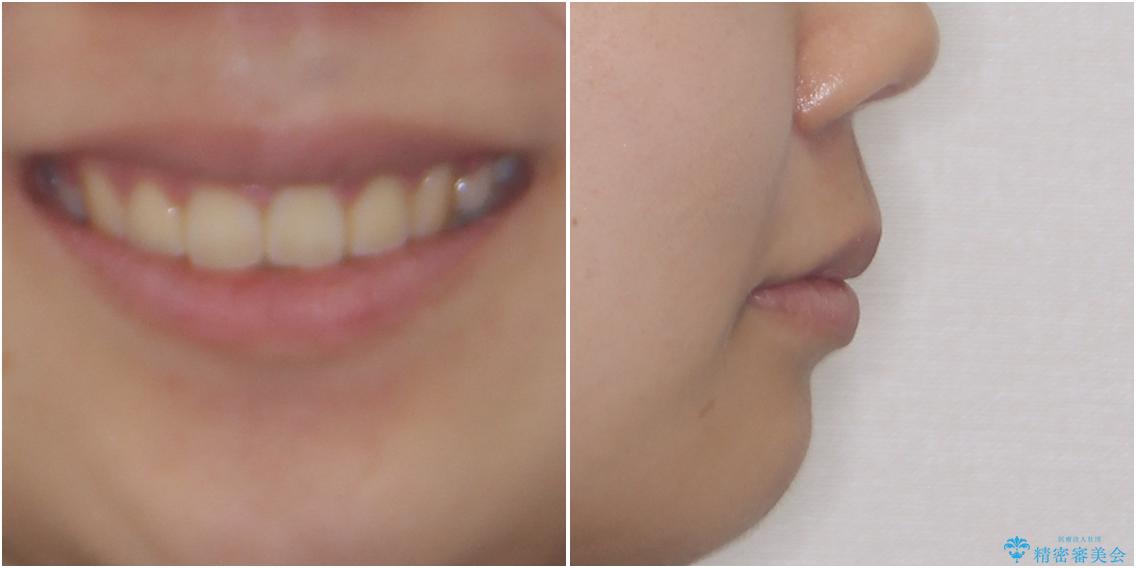 部分矯正で出っ歯になった　出っ歯改善の抜歯矯正の治療後（顔貌）