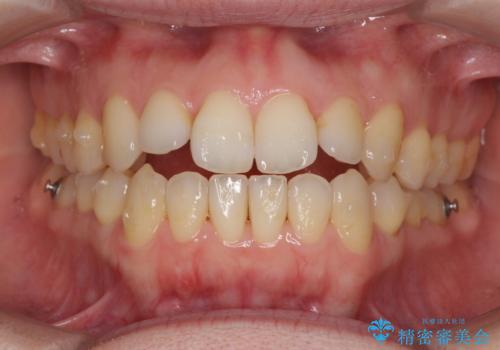 前歯の叢生とオープンバイト インビザラインでの矯正治療の治療中