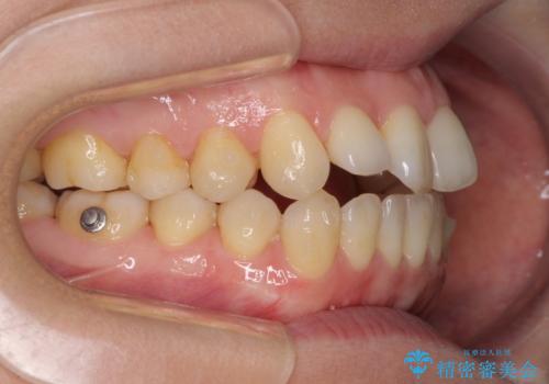 前歯の叢生とオープンバイト インビザラインでの矯正治療の治療中