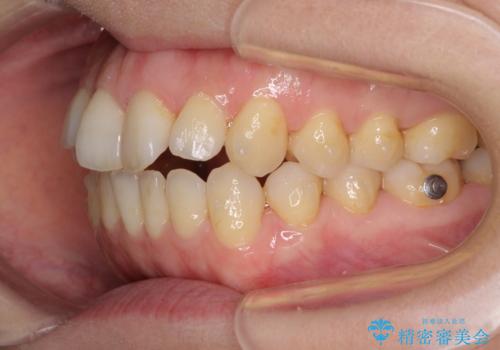 前歯の叢生とオープンバイト インビザラインでの矯正治療の治療中