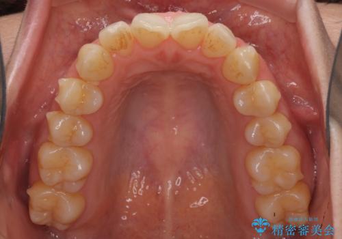 前歯の叢生とオープンバイト インビザラインでの矯正治療の治療中