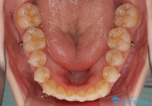 前歯の叢生とオープンバイト インビザラインでの矯正治療の治療中