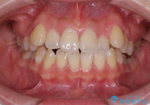 口元の突出感を改善　インビザラインによる非抜歯矯正の症例 治療前