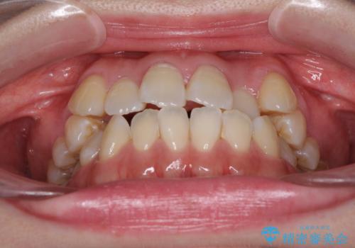 口元の突出感を改善 インビザラインによる非抜歯矯正の治療前