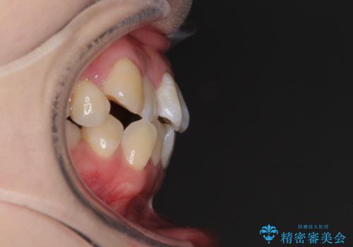 口元の突出感を改善 インビザラインによる非抜歯矯正の治療前