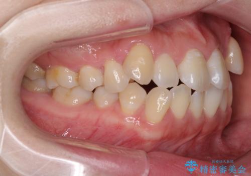 口元の突出感を改善 インビザラインによる非抜歯矯正の治療前