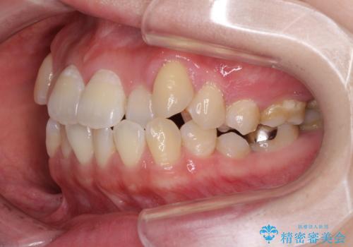 口元の突出感を改善　インビザラインによる非抜歯矯正の治療前