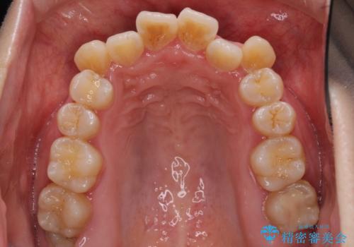 口元の突出感を改善　インビザラインによる非抜歯矯正の治療前