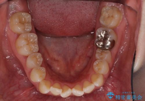 口元の突出感を改善 インビザラインによる非抜歯矯正の治療前