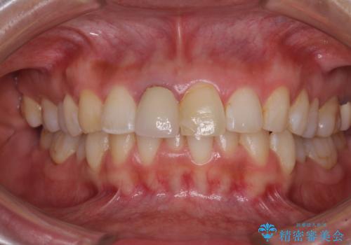 目立つ前歯の詰め物　オーダーメイドのセラミッククラウンで審美的に仕上げるの治療前
