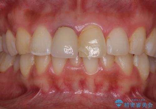 目立つ前歯の詰め物 オーダーメイドのセラミッククラウンで審美的に仕上げるの治療前