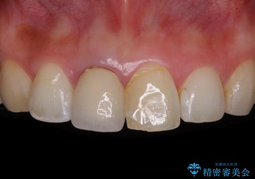 目立つ前歯の詰め物 オーダーメイドのセラミッククラウンで審美的に仕上げるの症例 治療前