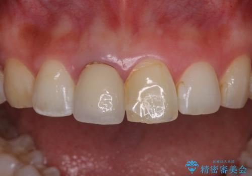 目立つ前歯の詰め物 オーダーメイドのセラミッククラウンで審美的に仕上げるの治療前