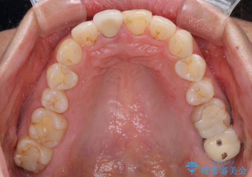 目立つ前歯の詰め物 オーダーメイドのセラミッククラウンで審美的に仕上げるの治療前