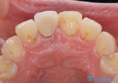 目立つ前歯の詰め物 オーダーメイドのセラミッククラウンで審美的に仕上げるの治療前