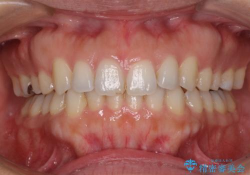 受け口傾向の前歯　すきっ歯の改善