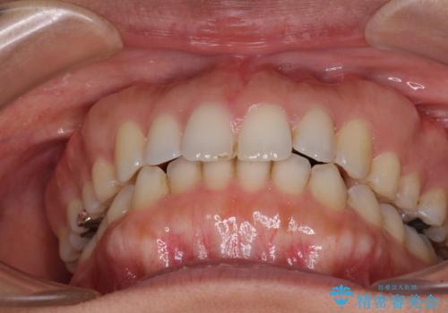 受け口傾向の前歯 すきっ歯の改善の治療後