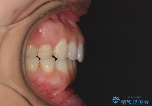 受け口傾向の前歯 すきっ歯の改善の治療後