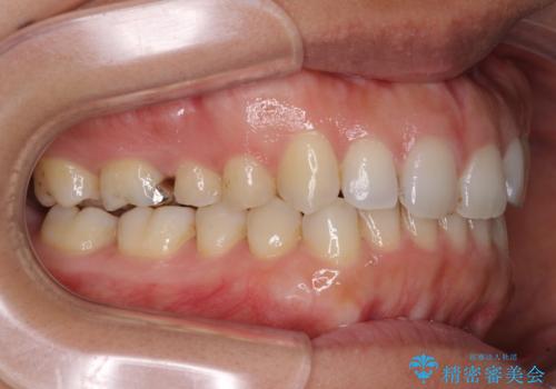 受け口傾向の前歯　すきっ歯の改善の治療後