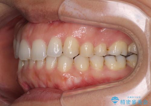 受け口傾向の前歯 すきっ歯の改善の治療後