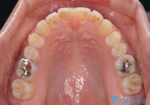 受け口傾向の前歯 すきっ歯の改善の治療後
