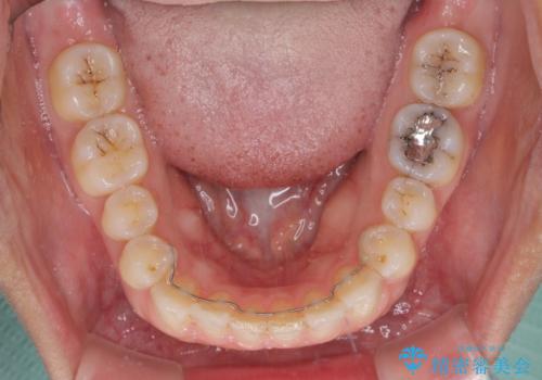 受け口傾向の前歯　すきっ歯の改善の治療後