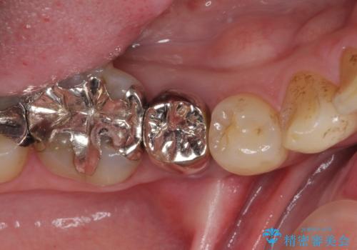 穴を開けられ抜歯となった奥歯　セラミックブリッジによる補綴治療の症例 治療前