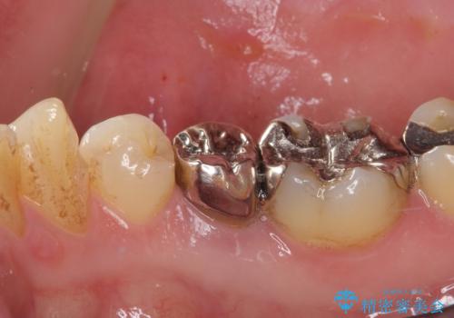 穴を開けられ抜歯となった奥歯 セラミックブリッジによる補綴治療の治療前