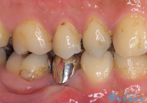 穴を開けられ抜歯となった奥歯　セラミックブリッジによる補綴治療の治療前
