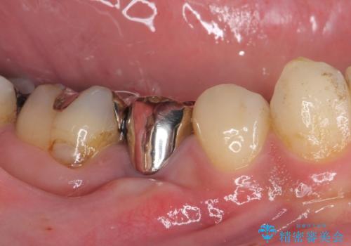 穴を開けられ抜歯となった奥歯　セラミックブリッジによる補綴治療の治療前