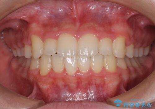 中学生のワイヤー矯正 クロスバイトを短期間で改善の治療後