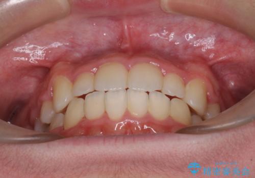 中学生のワイヤー矯正 クロスバイトを短期間で改善の治療後