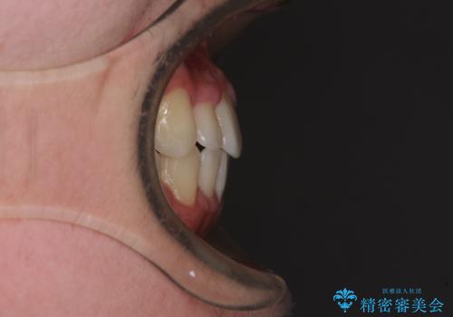 中学生のワイヤー矯正 クロスバイトを短期間で改善の治療後