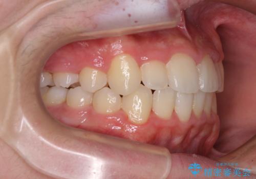 中学生のワイヤー矯正 クロスバイトを短期間で改善の治療後