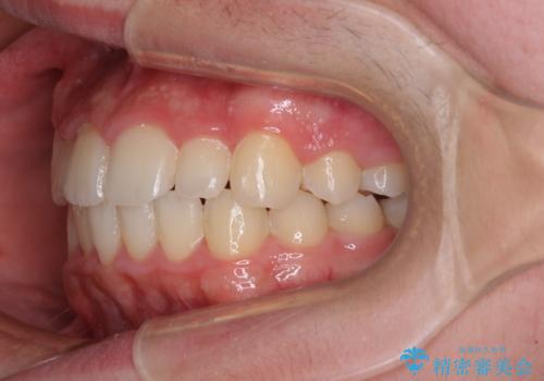 中学生のワイヤー矯正 クロスバイトを短期間で改善の治療後