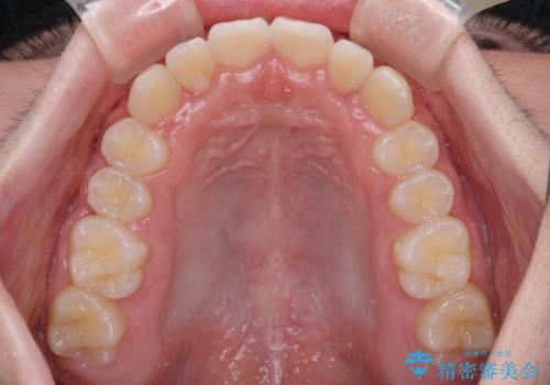 中学生のワイヤー矯正 クロスバイトを短期間で改善の治療後