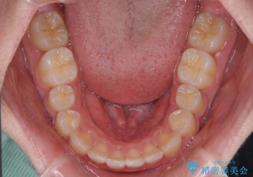 中学生のワイヤー矯正 クロスバイトを短期間で改善の治療後