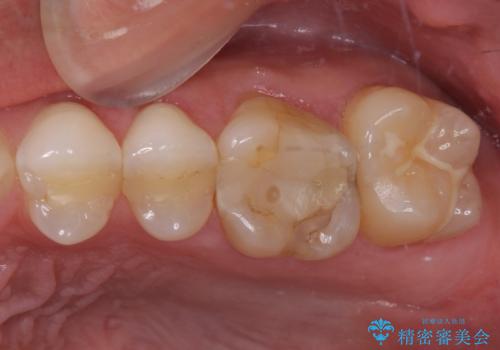 奥歯の詰め物が取れた　継ぎ接ぎだらけの詰め物をゴールドインレーにの症例 治療前